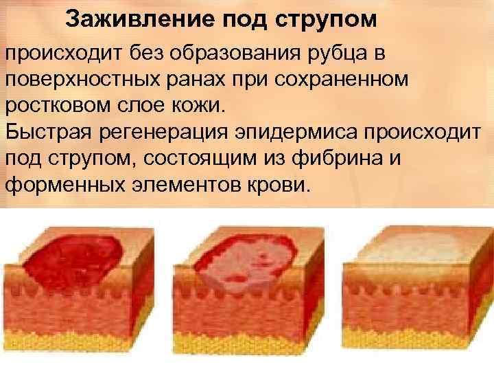 Грануляция раны фото