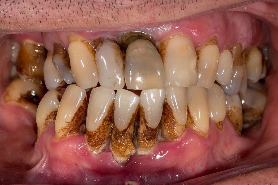 Пульпит и периодонтит зуба: причины появления, лечение и диагностика заболевания