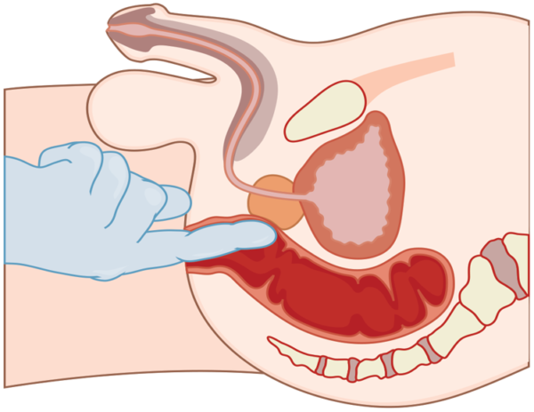 Полезен ли массаж простаты, техника выполнения