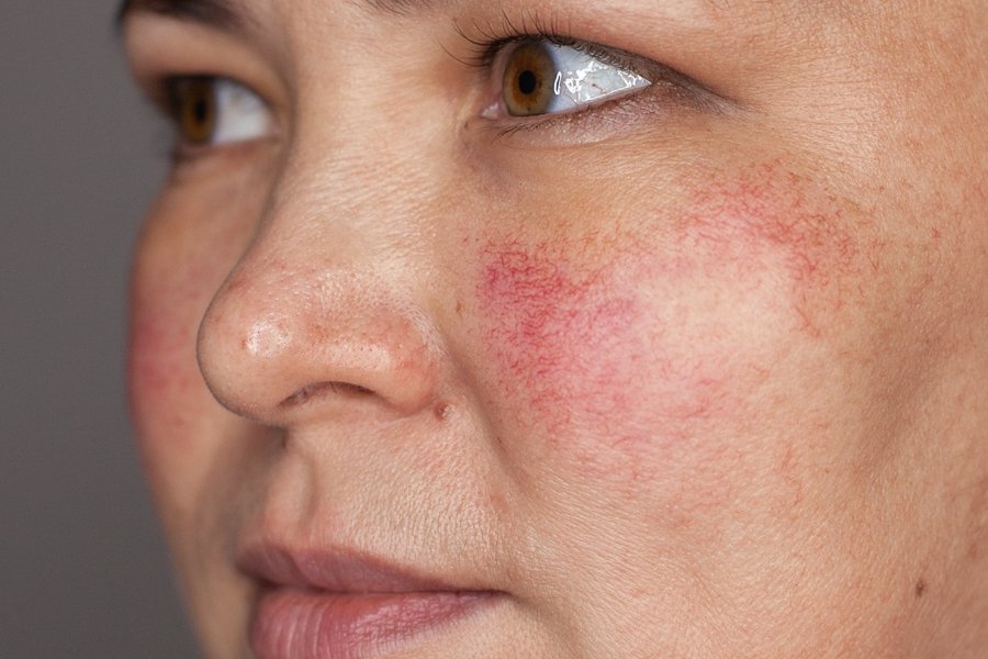 Лечение купероза на лице в домашних условиях: фото, отзывы, эффективные препараты
