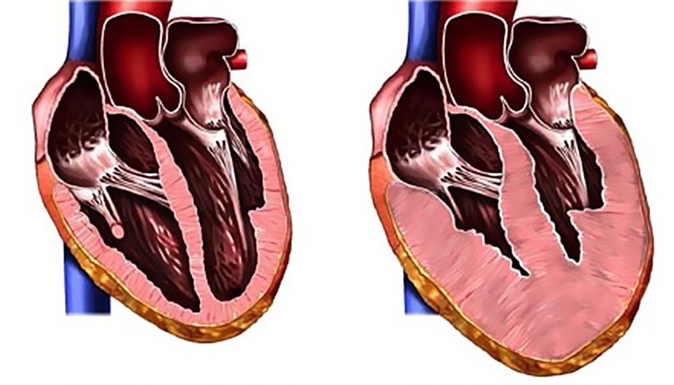 Гипертрофия сердца (миокарда желудочков и предсердий): причины, виды, симптомы и диагностика, как лечить