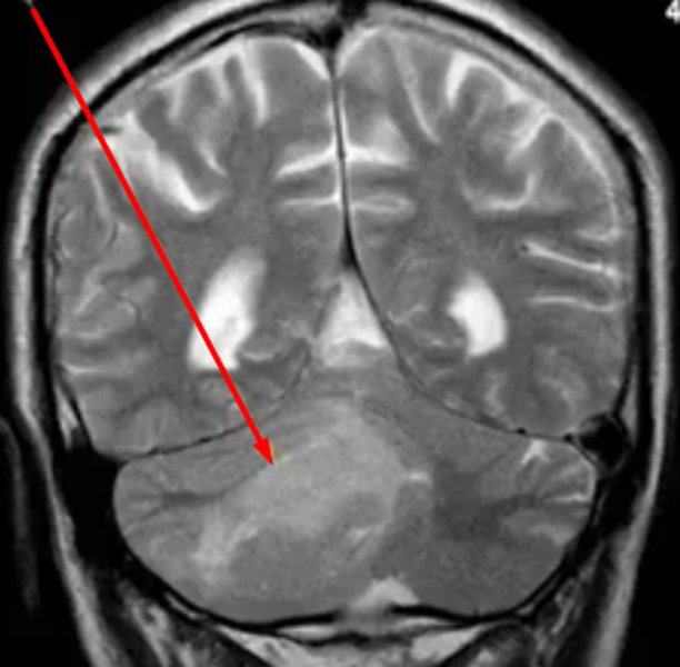 Кт головного мозга: показания и методика проведения диагностики