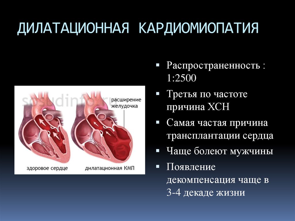Кардиомиопатия (кмп). классификация кардиомиопатий. диагностика и лечение