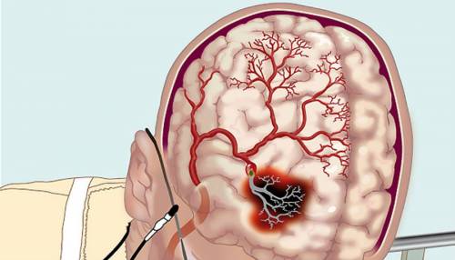 Причины острого нарушения мозгового кровообращения и разновидности патологии