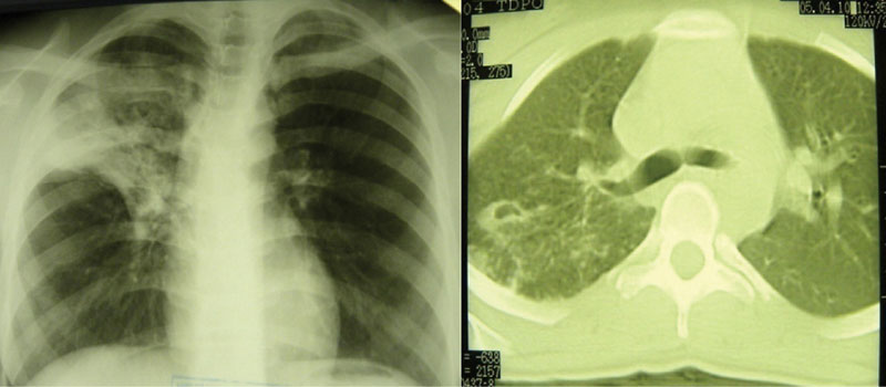Лечение туберкулеза легких: медикаментозная, хирургическая терапия