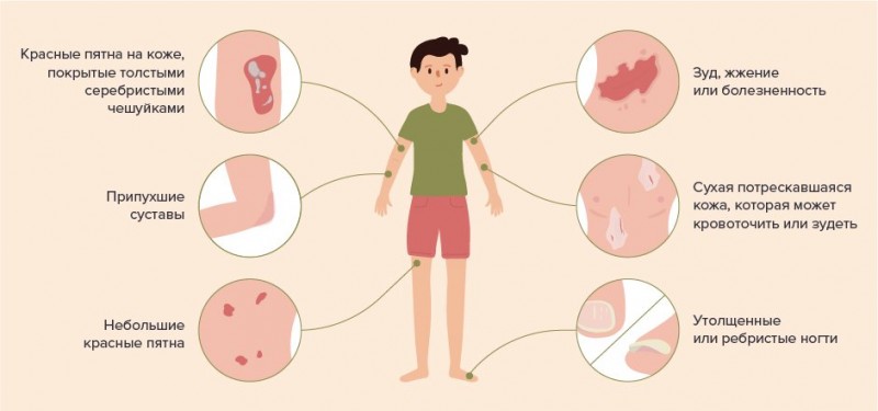 Как распознать псориаз? что это за болезнь? почему болеет кожа?