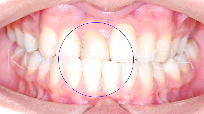 Правильный прикус зубов у человека: важность и особенности лечения, окклюзия и виды