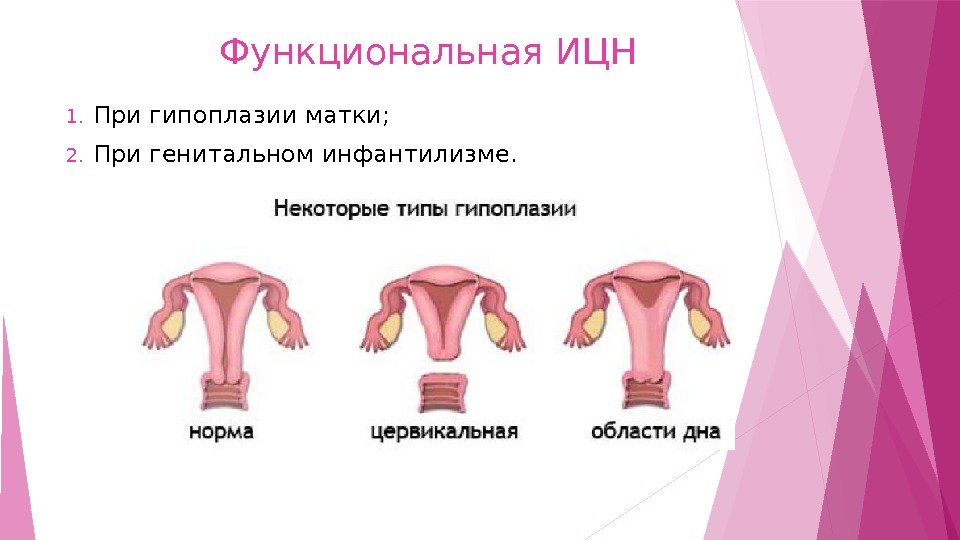 Как определить гипоплазию матки и сохранить репродуктивную функцию?