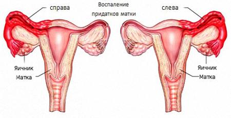 Воспаление придатков: симптомы у женщин, лечение и антибиотики