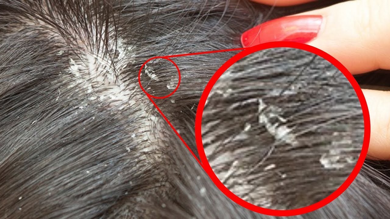 Гниды на волосах: что это, как выглядят, откуда берутся и чем лечить?