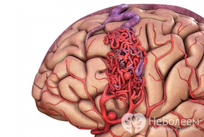 Микроангиопатия головного мозга: причины, симптомы, последствия
