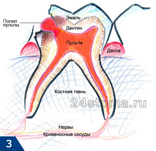 Периодонтит зуба: его виды, симптомы, диагностика и осложнения