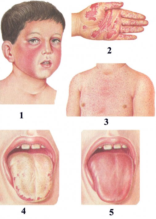 Симптомы и лечение скарлатины у детей