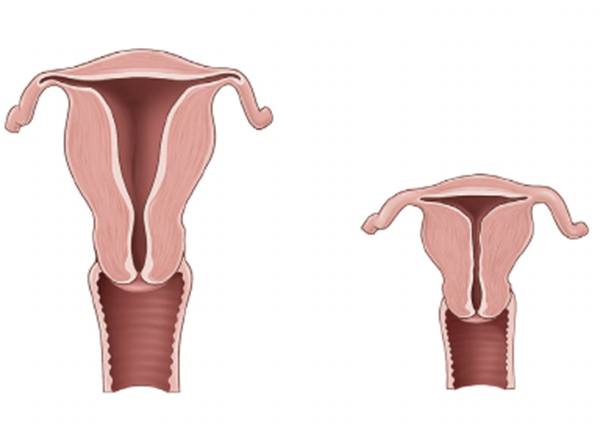 Гиперплазия эндометрия матки у женщин: что это такое, чем опасна, последствия, признаки, лечение заболевания