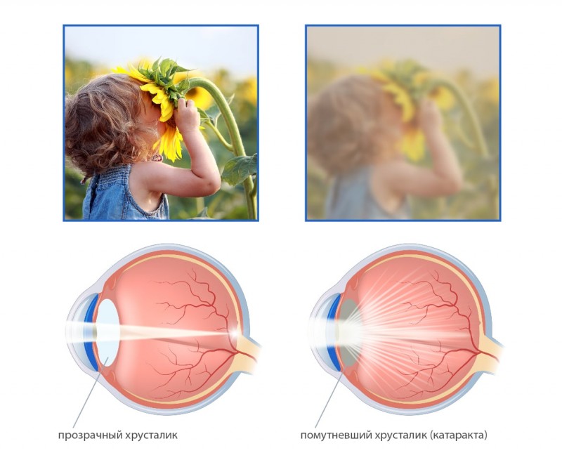 Почему катаракта так опасна и как от неё избавиться