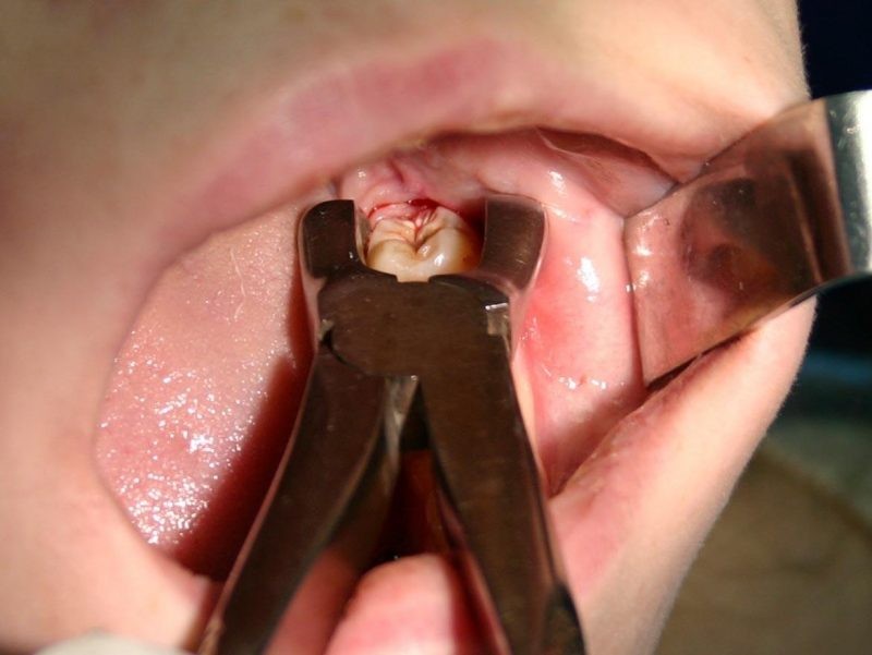 Симптомы роста зубов мудрости и способы облегчения процесса