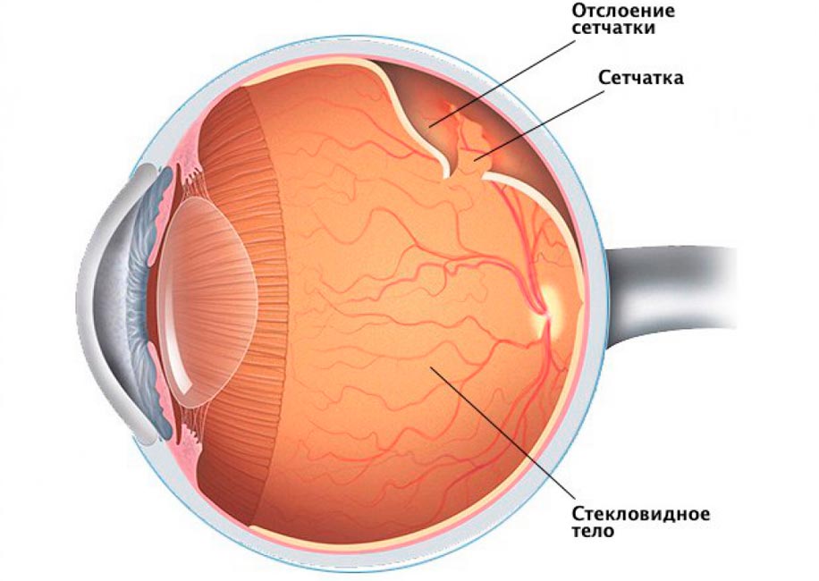 Сетчатка глаза: заболевания и лечение сетчатки
