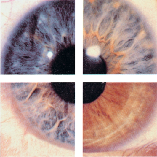 Гетерохромия глаз: центральная, частичная, секторная у людей и животных. как заболеть и изменить цвет радужки.