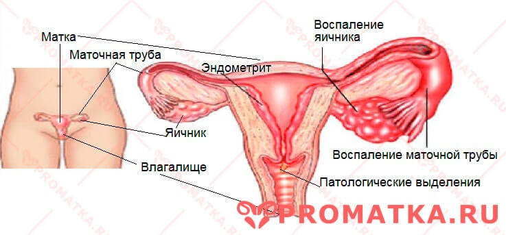 Что такое подострый эндометрит: его симптомы, причины появления, диагностика, лечение и отзывы женщин о нем