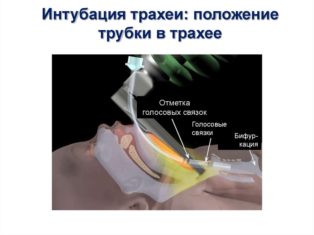 Интубация трахеи. Интубация трахеи методика. Интубация трахеи схема. Техника интубации трахеи. Трубка для интубации трахеи.