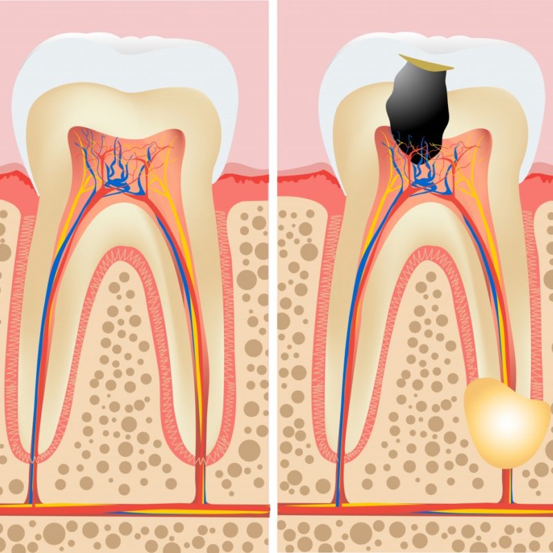 Причины воспаления пульпы зуба - симптомы и причины возникновения пульпита