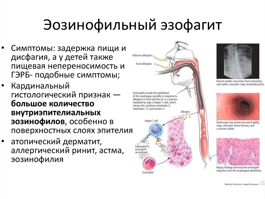 Синдром пищевода. Классификация эзофагитов патанатомия. Эндоскопическая классификация эозинофильного эзофагита. Рефлюкс эзофагит патанатомия. Патогенез эозинофильного эзофагита.