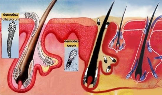 Демодекоз у человека