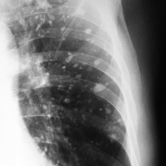 Болят ли легкие при туберкулезе: причины возникновения боли и лечение