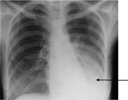 Туберкулема легких: чем опасна и что это такое?