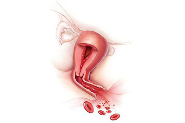 Кровотечение во время и после менструации: меноррагия, метроррагия