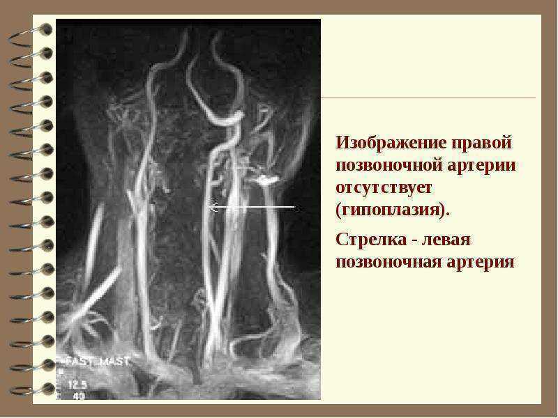 Гипоплазия правой позвоночной артерии: что это такое, симптомы и лечение