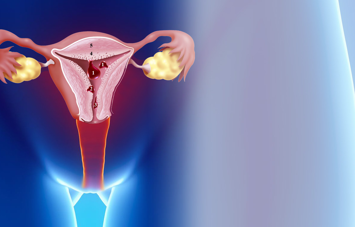 Полип эндометрия в матке: причины, симптомы, лечение и удаление
