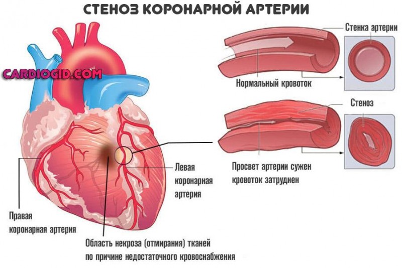 Что такое обширный инфаркт сердца и его последствия