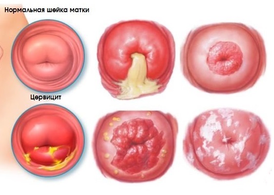 Хронический цервицит (воспаление шейки матки) – симптомы, лечение, препараты