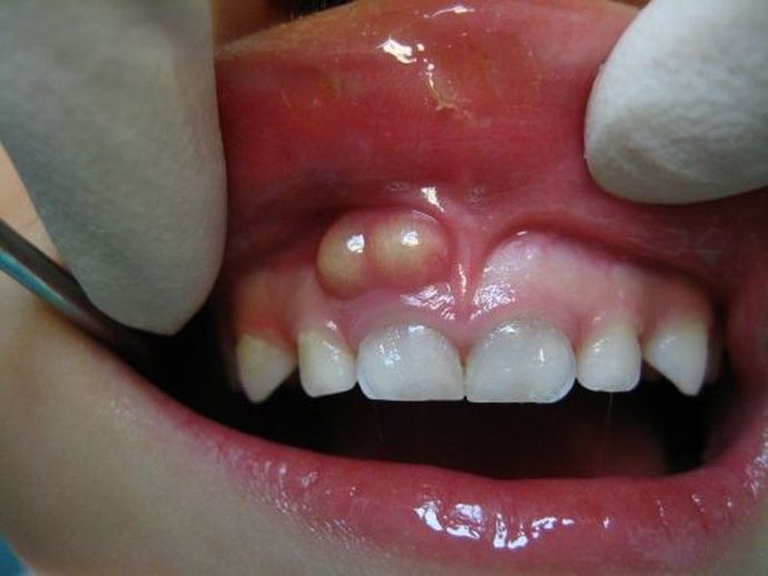 Что такое зубной флюс, как он выглядит и как с ним справиться: советы стоматологов и обзор способов лечения и профилактики