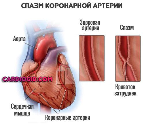 Что такое обширный инфаркт сердца и его последствия