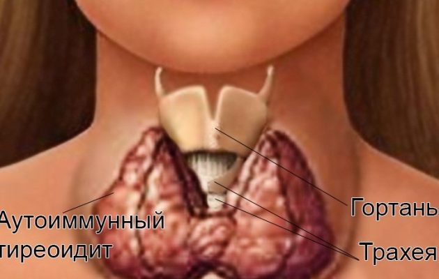 Аит щитовидной железы: что это такое, насколько недуг опасен