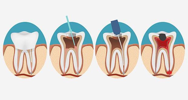 Что такое пульпит зуба и как его лечить?