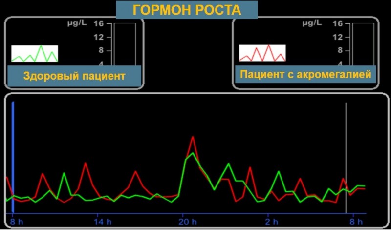 Акромегалия