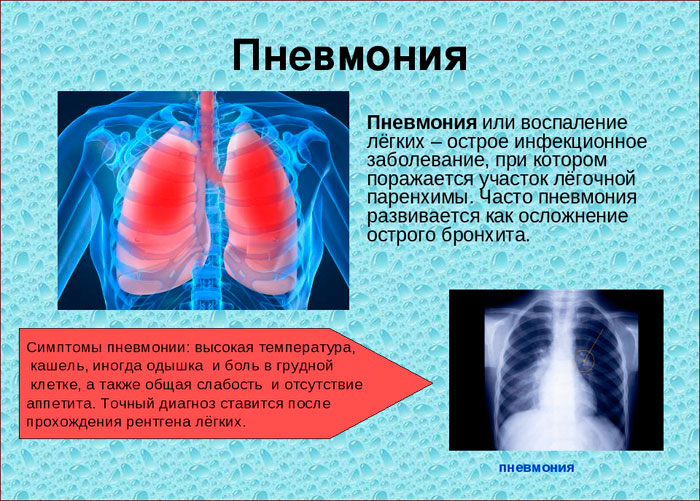 Характерные симптомы двусторонней пневмонии