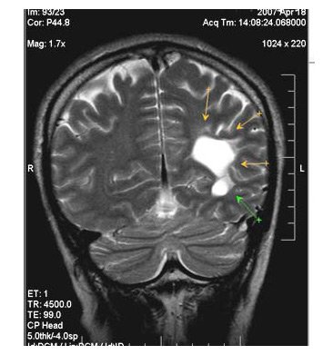 Микроангиопатия головного мозга - что это такое, причины, диагностика и лечение