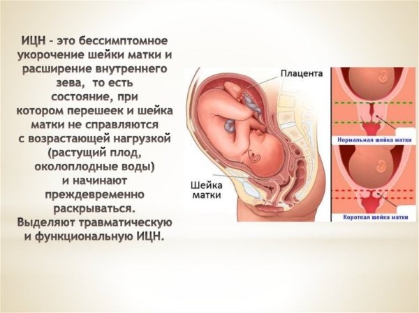 Тонус и гипертонус матки при беременности: симптомы и причины