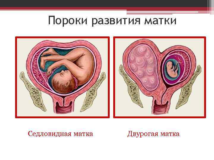 Двурогая матка - как выглядит с фото, признаки аномалии, симптомы и лечение
