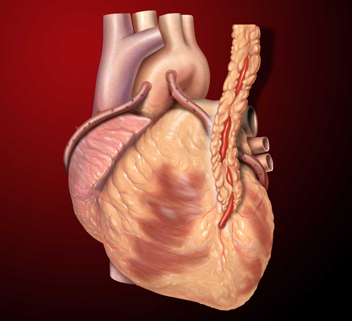 Что такое шунтирование клапана. сколько и как живут люди после шунтирования сосудов сердца