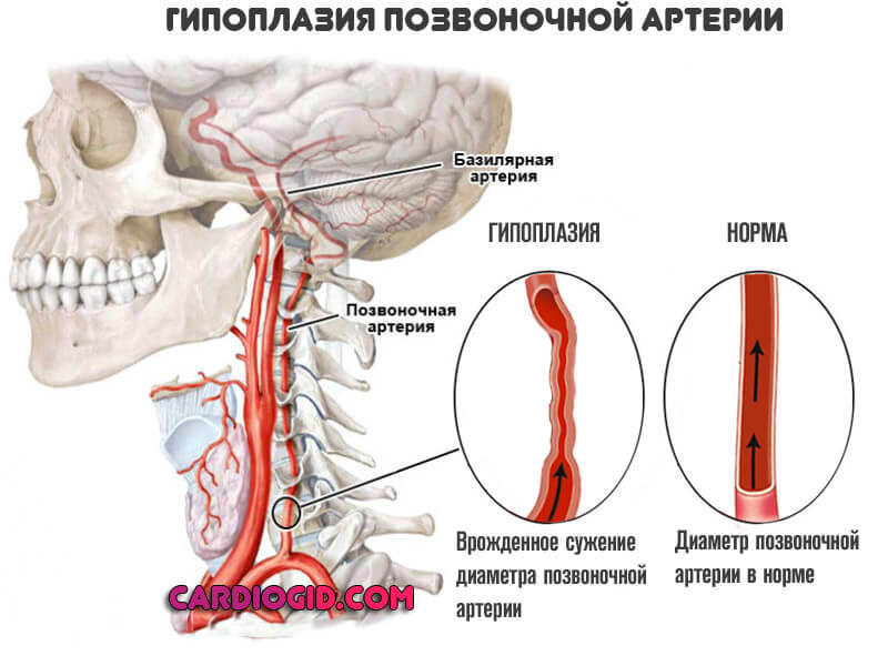 Гипоплазия правой позвоночной артерии: что это такое, причины и лечение