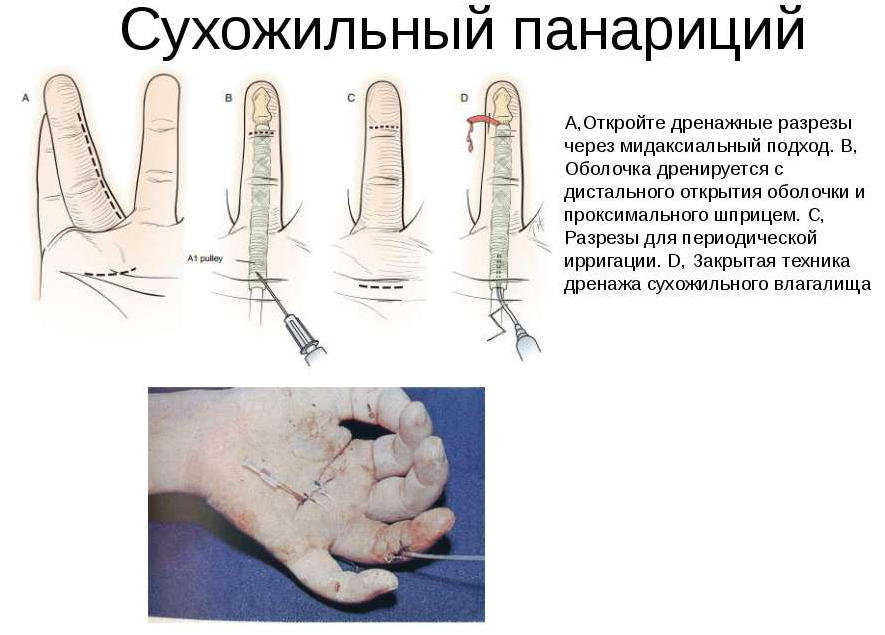Панариций: причины возникновения на пальцах рук и ног, лечение мазями и антибиотиками
