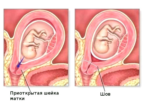 Цервикометрия при беременности
