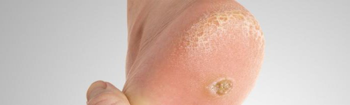 Причины и лечение фолликулярного гиперкератоза кожи кремами и мазями для детей и взрослых