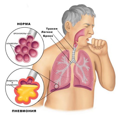 Двухсторонняя пневмония: как вылечить воспаление легких?