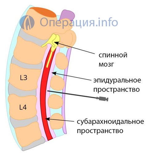 Эпидуральная анестезия - показания при родах или операциях. как делают и последствия эпидуральной анестезии